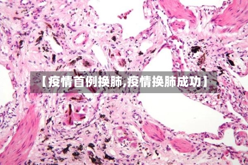 【疫情首例换肺,疫情换肺成功】